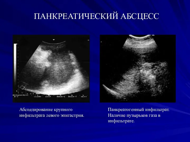 ПАНКРЕАТИЧЕСКИЙ АБСЦЕСС Абсцедирование крупного инфильтрата левого эпигастрия. Панкреатогенный инфильтрат. Наличие пузырьков газа в инфильтрате.