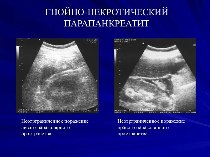 ГНОЙНО-НЕКРОТИЧЕСКИЙ ПАРАПАНКРЕАТИТ Неотрграниченное поражение левого параколярного пространства. Неотрграниченное поражение правого параколярного пространства.