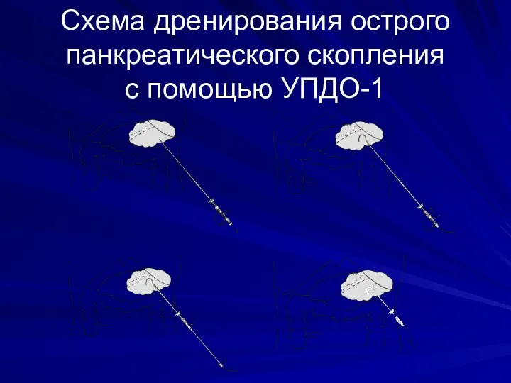 Схема дренирования острого панкреатического скопления с помощью УПДО-1