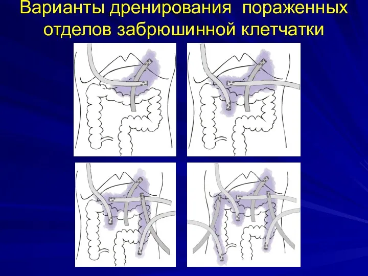 Варианты дренирования пораженных отделов забрюшинной клетчатки