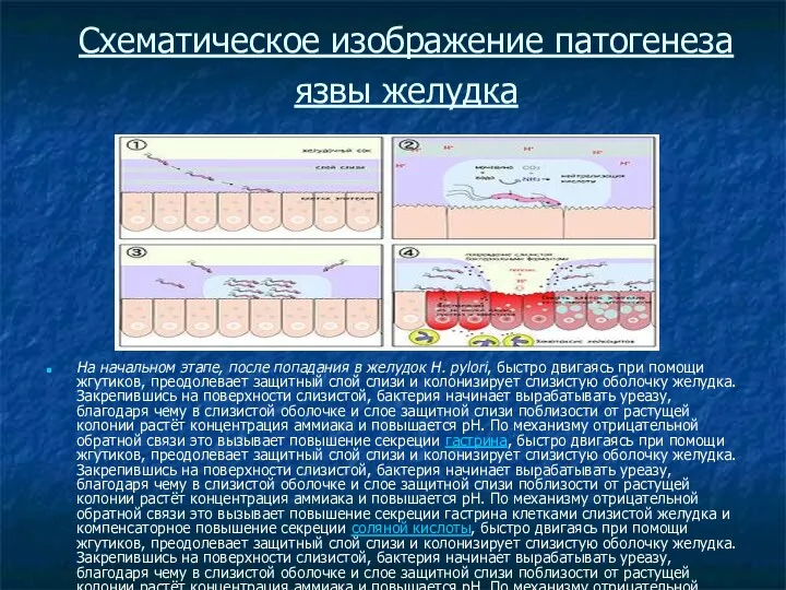 Схематическое изображение патогенеза язвы желудка На начальном этапе, после попадания