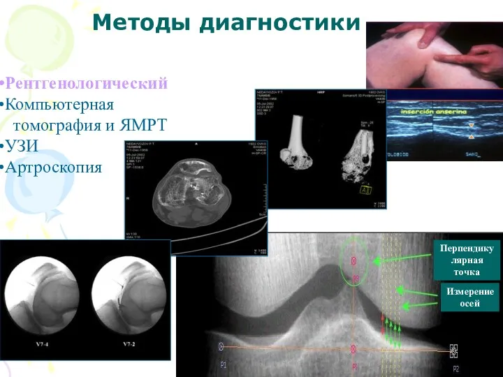 Методы диагностики Рентгенологический Компьютерная томография и ЯМРТ УЗИ Артроскопия