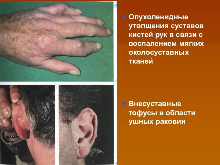 Опухолевидные утолщения суставов кистей рук в связи с воспалением мягких