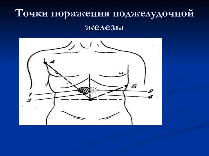 Точки поражения поджелудочной железы