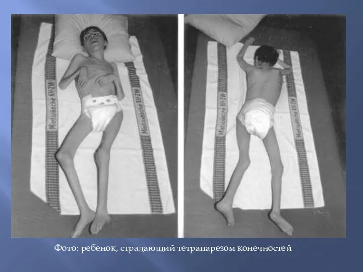 Фото: ребенок, страдающий тетрапарезом конечностей