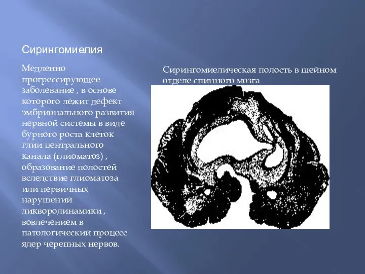 Сирингомиелия Медленно прогрессирующее заболевание , в основе которого лежит дефект