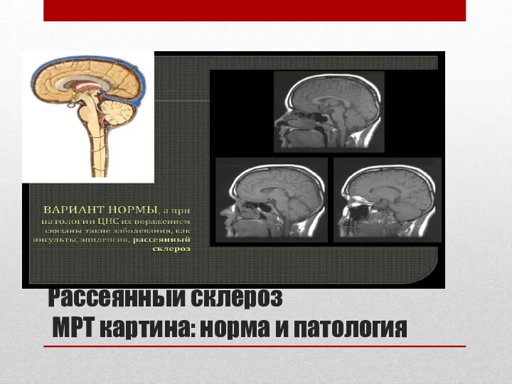 Рассеянный склероз МРТ картина: норма и патология