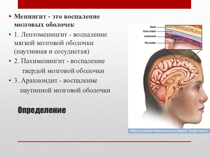 Определение Менингит - это воспаление мозговых оболочек 1. Лептоменингит -