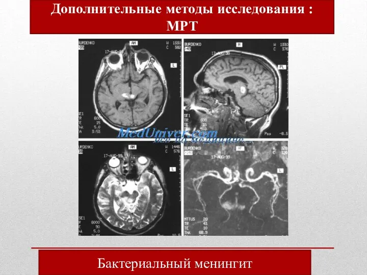 Бактериальный менингит Дополнительные методы исследования : МРТ