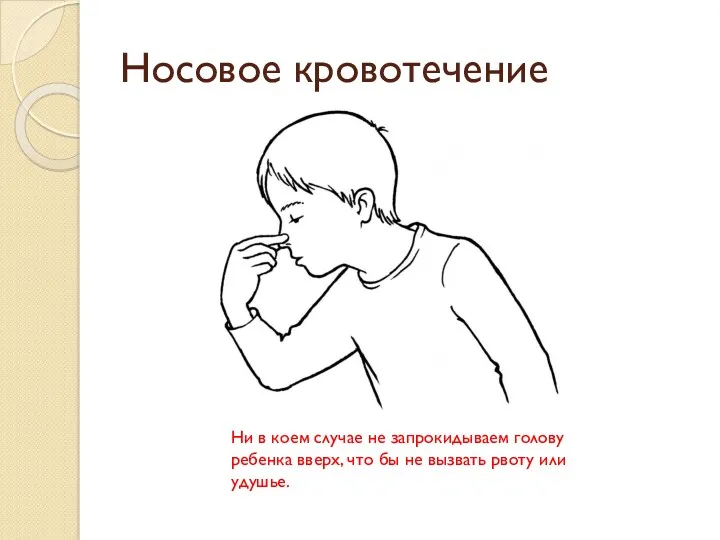 Носовое кровотечение Ни в коем случае не запрокидываем голову ребенка вверх, что бы