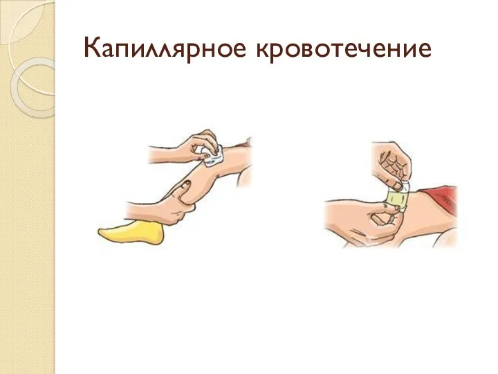 Капиллярное кровотечение