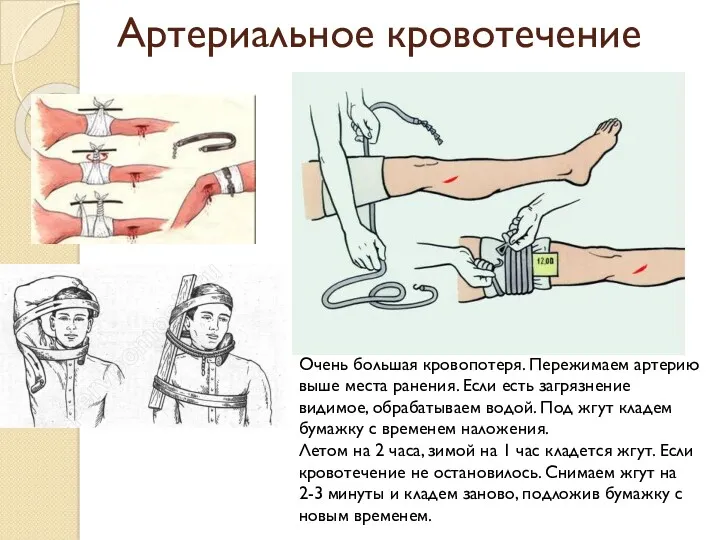 Артериальное кровотечение Очень большая кровопотеря. Пережимаем артерию выше места ранения.