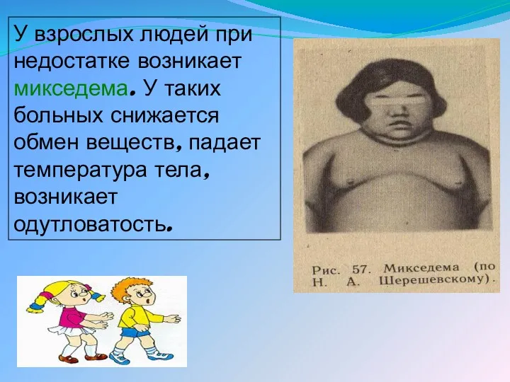 У взрослых людей при недостатке возникает микседема. У таких больных