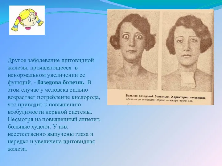 Другое заболевание щитовидной железы, проявляющееся в ненормальном увеличении ее функций,