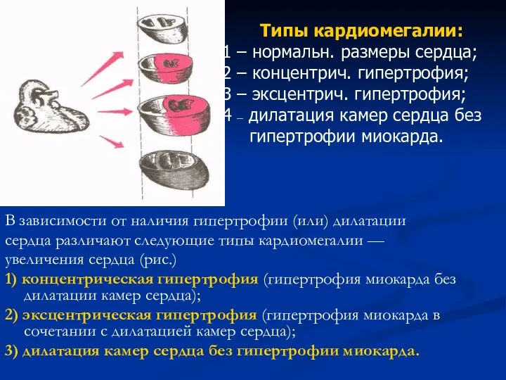 В зависимости от наличия гипертрофии (или) дилатации сердца различают следующие