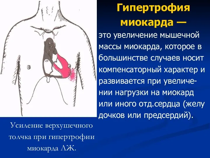 Усиление верхушечного толчка при гипертрофии миокарда ЛЖ. Гипертрофия миокарда —