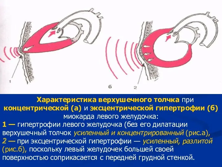 Характеристика верхушечного толчка при концентрической (а) и эксцентрической гипертрофии (б)