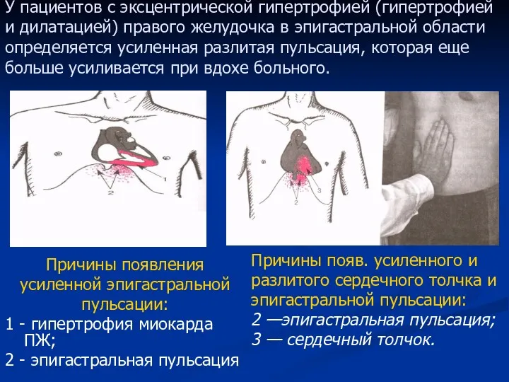 У пациентов с эксцентрической гипертрофией (гипертрофией и дилатацией) правого желудочка