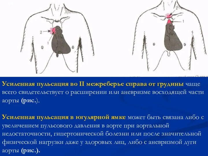 Усиленная пульсация во II межреберье справа от грудины чаще всего