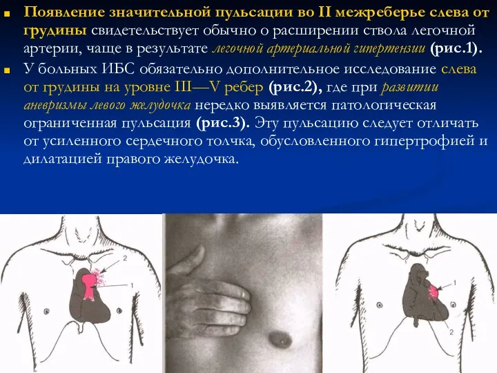 Появление значительной пульсации во II межреберье слева от грудины свидетельствует