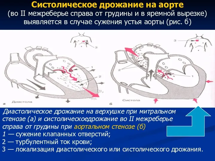 Систолическое дрожание на аорте (во II межреберье справа от грудины