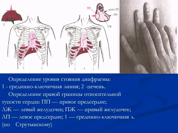 Определение уровня стояния диафрагмы: 1 - срединно-ключичная линия; 2 -печень.