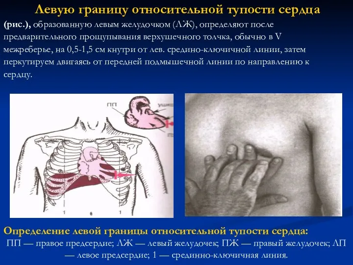 Левую границу относительной тупости сердца (рис.), образованную левым желудочком (ЛЖ),