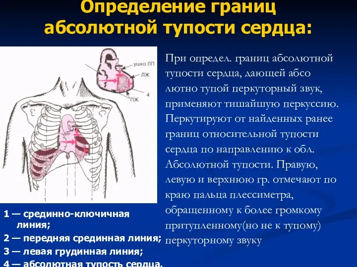 Определение границ абсолютной тупости сердца: 1 — срединно-ключичная линия; 2