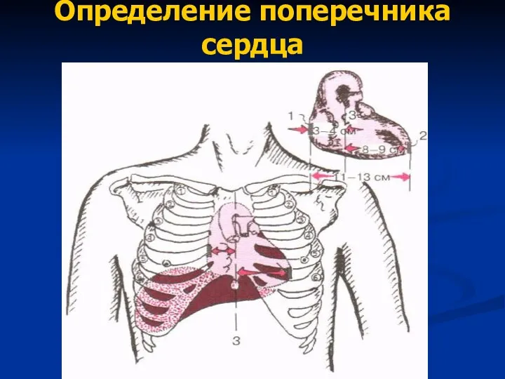 Определение поперечника сердца