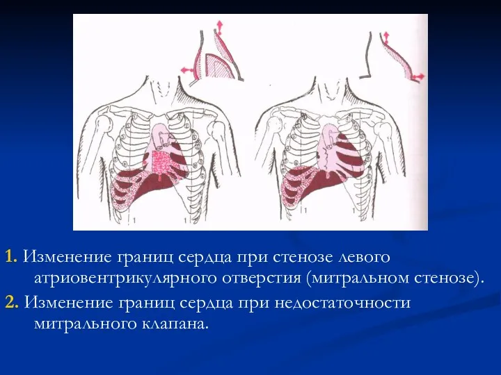 1. Изменение границ сердца при стенозе левого атриовентрикулярного отверстия (митральном