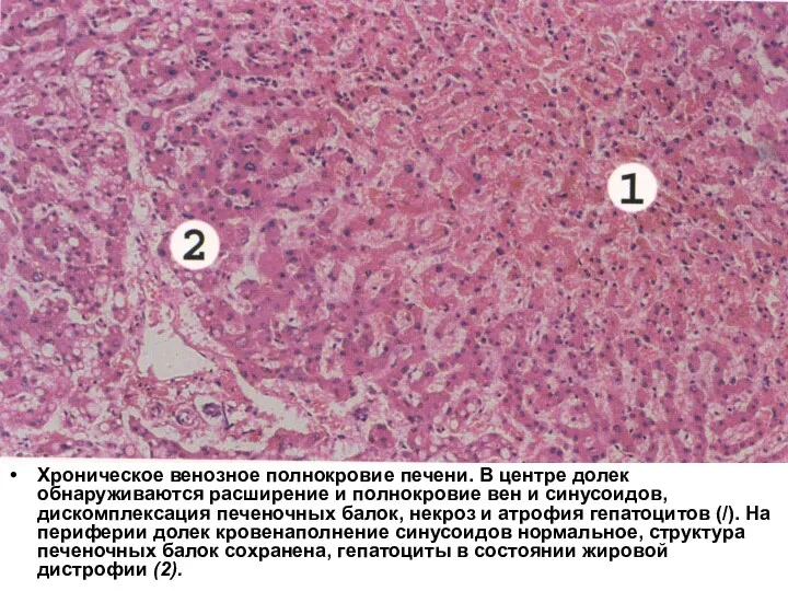 Хроническое венозное полнокровие печени. В центре долек обнаруживаются расширение и