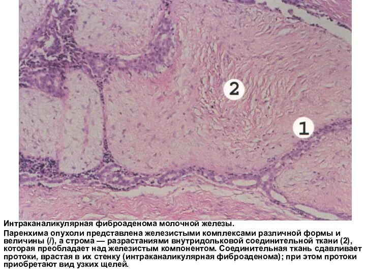 Интраканаликулярная фиброаденома молочной железы. Паренхима опухоли представлена железистыми комплексами различной