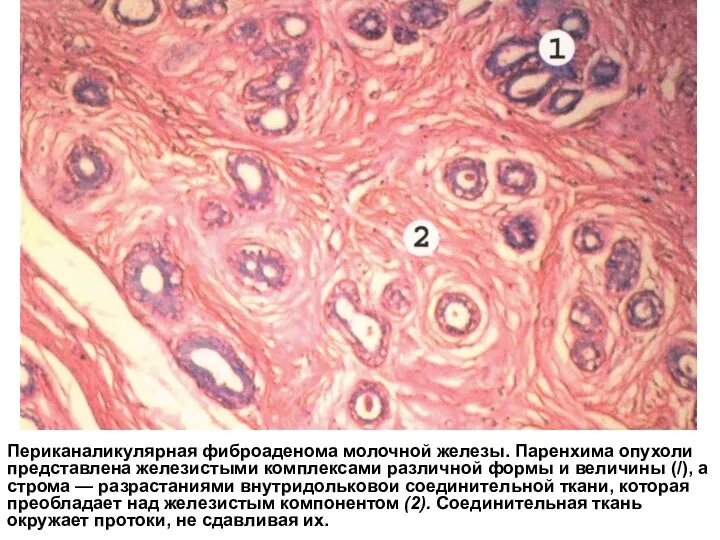 Периканаликулярная фиброаденома молочной железы. Паренхима опухоли представлена железистыми комплексами различной