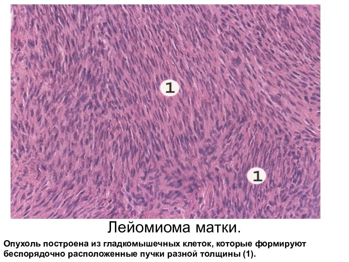 Лейомиома матки. Опухоль построена из гладкомышечных клеток, которые формируют беспорядочно расположенные пучки разной толщины (1).