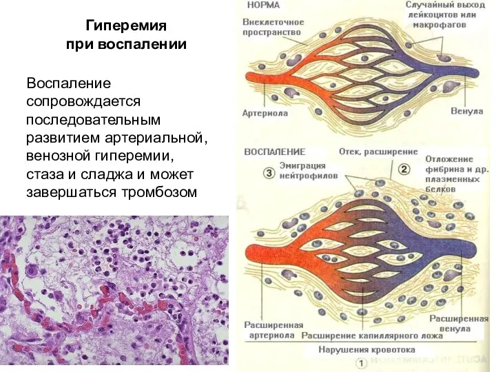 Гиперемия при воспалении Воспаление сопровождается последовательным развитием артериальной, венозной гиперемии,
