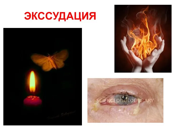 ЭКССУДАЦИЯ