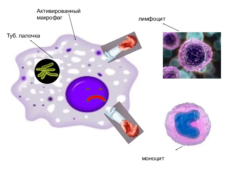 Туб. палочка Активированный макрофаг лимфоцит моноцит