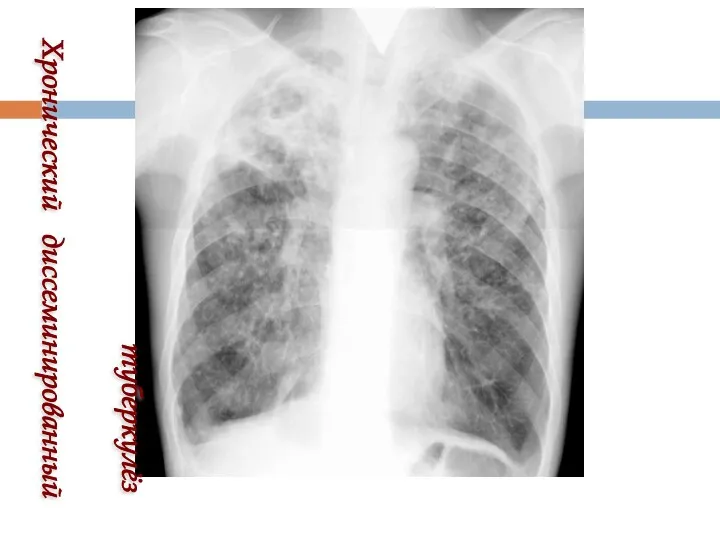 Хронический диссеминированный туберкулёз