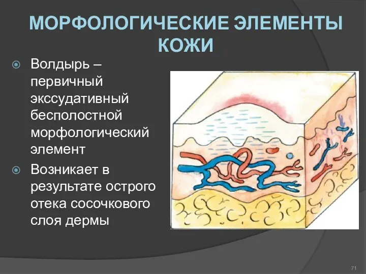 МОРФОЛОГИЧЕСКИЕ ЭЛЕМЕНТЫ КОЖИ Волдырь – первичный экссудативный бесполостной морфологический элемент