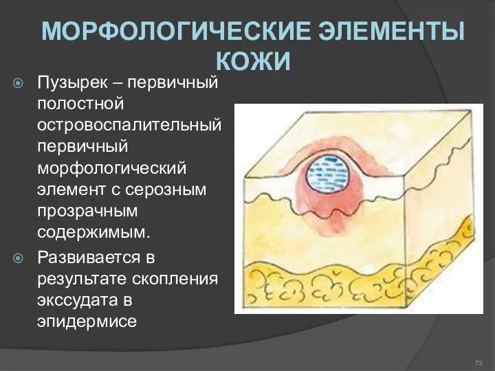 МОРФОЛОГИЧЕСКИЕ ЭЛЕМЕНТЫ КОЖИ Пузырек – первичный полостной островоспалительный первичный морфологический