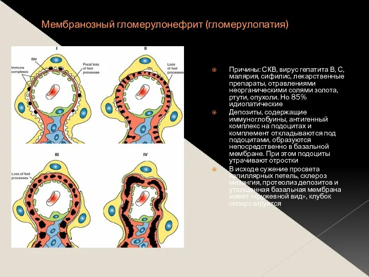 Мембранозный гломерулонефрит (гломерулопатия) Причины: СКВ, вирус гепатита В, С, малярия,