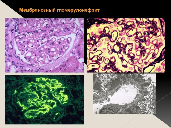 Мембранозный гломерулонефрит