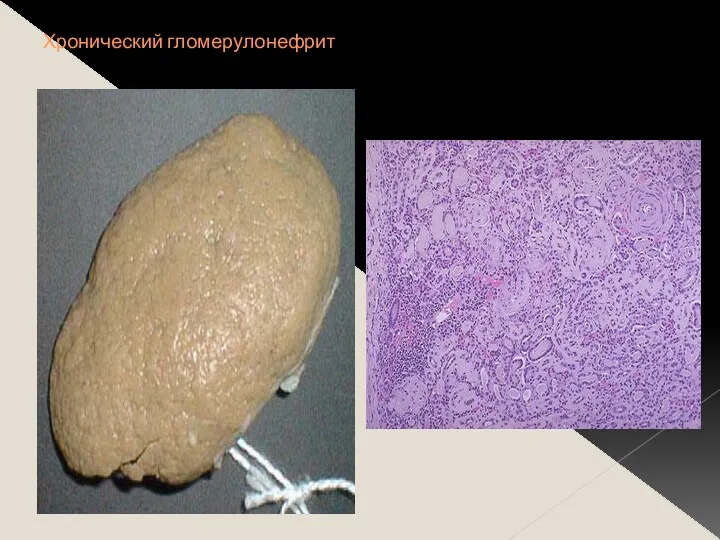Хронический гломерулонефрит