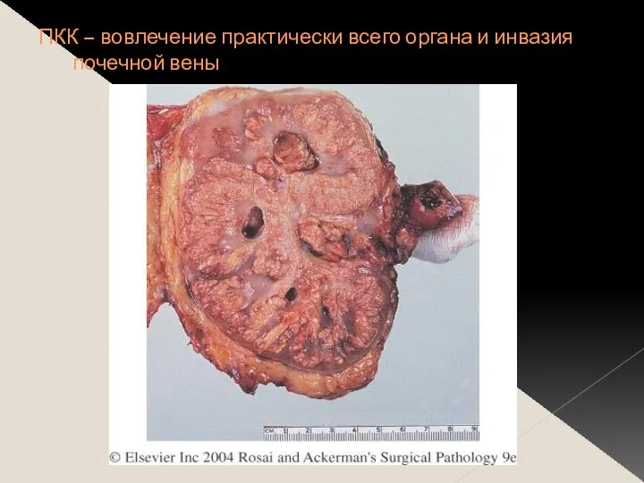 ПКК – вовлечение практически всего органа и инвазия почечной вены