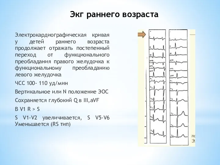 Экг раннего возраста Электрокардиографическая кривая у детей раннего возраста продолжает отражать постепенный переход