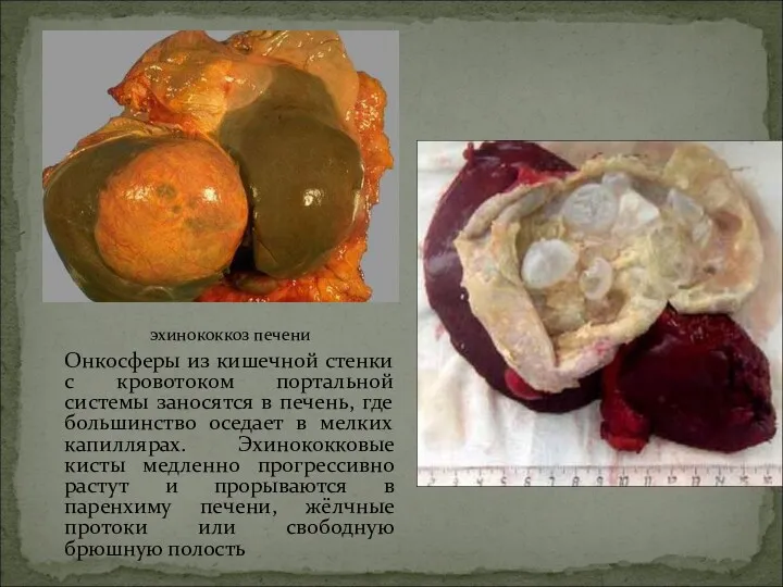 эхинококкоз печени Онкосферы из кишечной стенки с кровотоком портальной системы