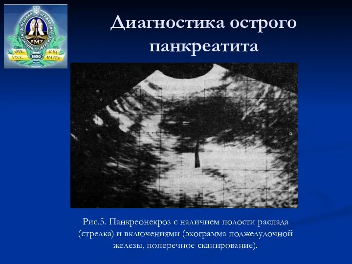 Диагностика острого панкреатита Рис.5. Панкреонекроз с наличием полости распада (стрелка)