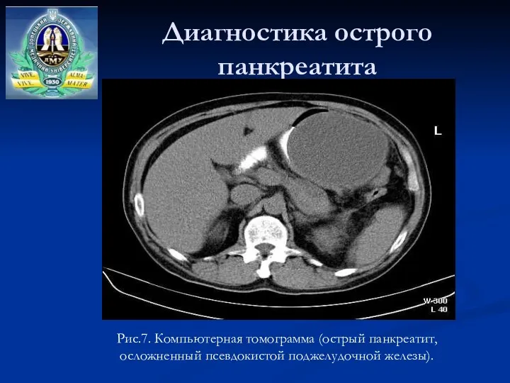 Диагностика острого панкреатита Рис.7. Компьютерная томограмма (острый панкреатит, осложненный псевдокистой поджелудочной железы).