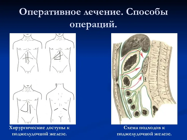 Оперативное лечение. Способы операций. Хирургические доступы к поджелудочной железе. Схема подходов к поджелудочной железе.