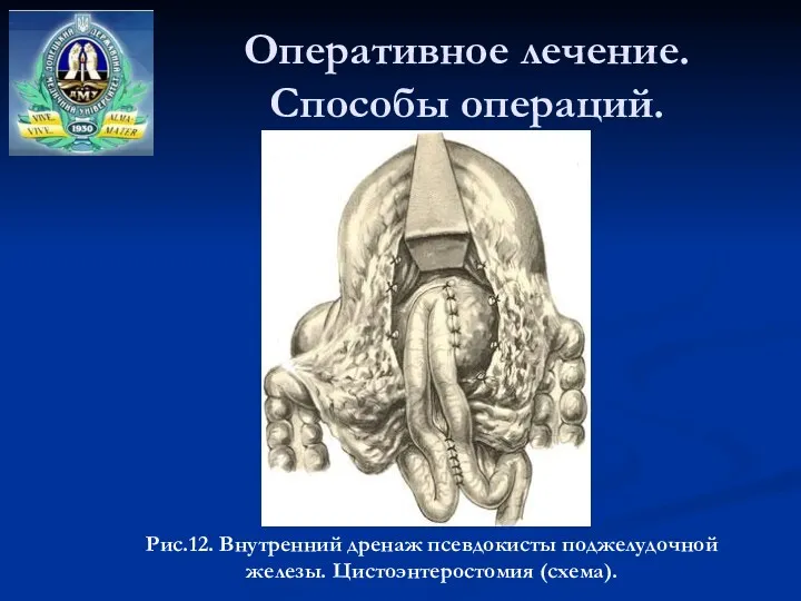 Оперативное лечение. Способы операций. Рис.12. Внутренний дренаж псевдокисты поджелудочной железы. Цистоэнтеростомия (схема).